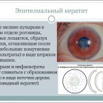 Эпителиальная форма кератита