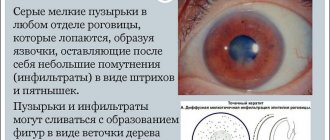 Эпителиальная форма кератита