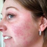 Если красные глаза и отеки после алкоголя