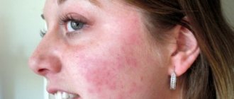 If your eyes are red and swollen after drinking alcohol