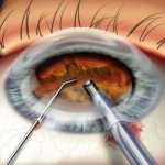 Phacoemulsification of cataracts