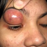 Фото абсцесса верхнего века у женщины