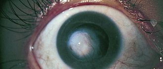 фото бельма (лейкомы) роговицы глаза