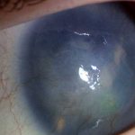 фото глаза без хрусталика