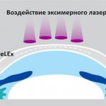 ФРК - операция докоррекции после ранее проведенно лазерной коррекции зрения