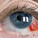 гемофтальм глаза