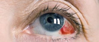 hemophthalmos of the eye