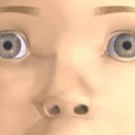 Гипертелоризм