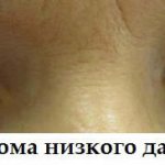 Глаукома - внутриглазное давление