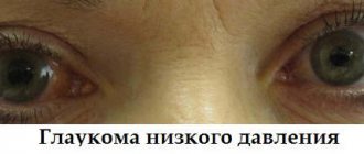 Глаукома - внутриглазное давление