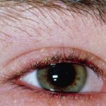 Глазной клещ — описание, симптомы заражение, осложнения, эффективное лечение