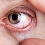 Грибковая инфекция глаза