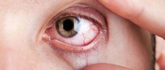 Грибковая инфекция глаза