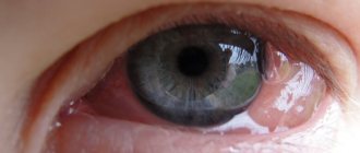 Хемоз глаза