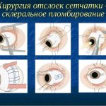 Хирургическое вмешательство