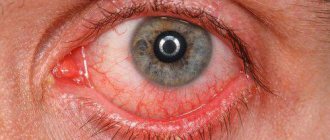 Chronic conjunctivitis treatment with folk remedies