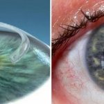 Имплантация интрастромальных колец