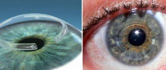 Имплантация интрастромальных колец