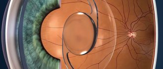 Интраокулярные линзы (ИОЛ)