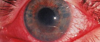 iritis and iridocyclitis