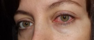 How to determine viral or bacterial conjunctivitis