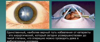 Как вести себя после операции по удалению катаракты глаза (замене хрусталика на иол)