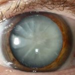 Катаракта глаза