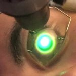 Keratoconus