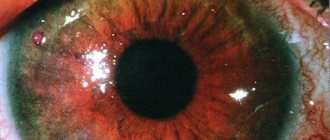 Keratoconjunctivitis