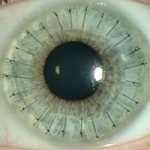 Кератопластика