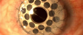 Кератопротез