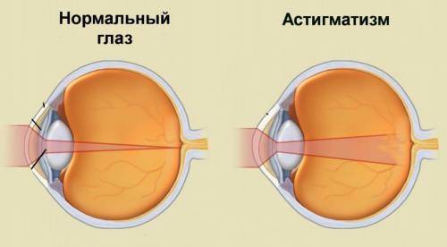 Комплекс упражнений глаз по методике профессора жданова - отзывы