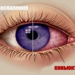 Conjunctivitis of the eye