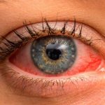 Конъюнктивит