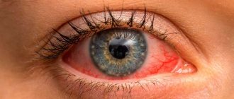 Conjunctivitis
