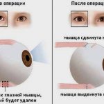 Strabismus in newborns: 6 factors of strabismus in infants, true strabismus