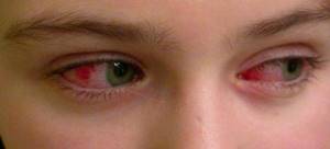 красные глаза при конъюктивите