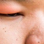 красный глаз