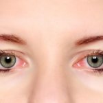 Кровоизлияние