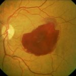 Retinal hemorrhage