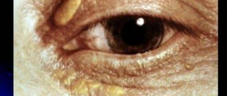 Ксантелазмы век: лечение народными средствами