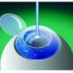 ЛАСИК коррекция зрения при астигматизме