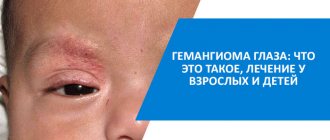 treatment of eye hemangioma