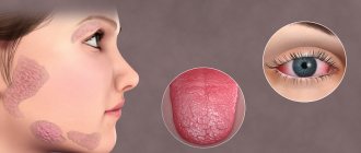 лечение синдрома шегрена в европе