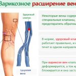 Лопаются капилляры на ногах, появляются синяки, пятна. Что делать, причины и лечение