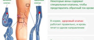Лопаются капилляры на ногах, появляются синяки, пятна. Что делать, причины и лечение