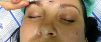 механический способ удаления поросянки на лице