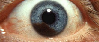 Меланома хориоидеи глаза