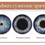 миоз зрачка