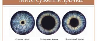 miosis of the pupil
